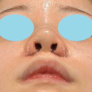 新宿ラクル美容外科クリニック　山本厚志　「貴族手術（鼻翼基部プロテーゼ）＋ 小鼻縮小+α法＋鼻プロテーゼ隆鼻術」　手術直後　２月２７日