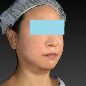 新宿ラクル美容外科クリニック　山本厚志　「アルテミスリフト」　手術直後　２月２３日