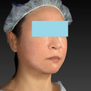 新宿ラクル美容外科クリニック　山本厚志　「アルテミスリフト」　手術後１週間目　２月２３日