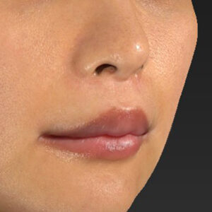 新宿ラクル美容外科クリニック　山本厚志　「人中短縮術（リップリフト）＋口角挙上（スマイルリップ）」　手術後１２ヶ月目　９月４日