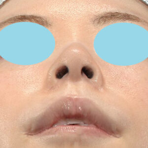 新宿ラクル美容外科クリニック　山本厚志　「小鼻縮小+α法 ＋ 鼻孔縁下降術」　手術後１２ヶ月目　２月２日