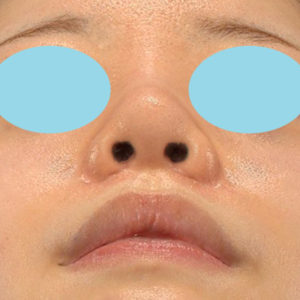 新宿ラクル美容外科クリニック　山本厚志　「貴族手術（鼻翼基部プロテーゼ）＋ 小鼻縮小+α法＋鼻プロテーゼ隆鼻術」　手術後１ヶ月目　２月２７日