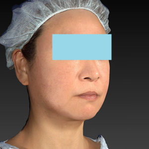 新宿ラクル美容外科クリニック　山本厚志　「アルテミスリフト」　手術後１ヶ月目　２月２３日