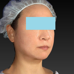 新宿ラクル美容外科クリニック　山本厚志　「アルテミスリフト」　手術後２ヶ月目　２月２３日