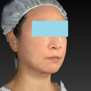 新宿ラクル美容外科クリニック　山本厚志　「アルテミスリフト」　手術後３ヶ月目　3月２３日