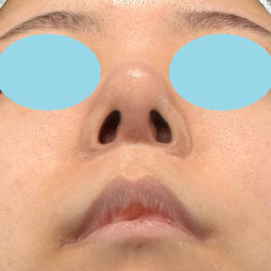 「鼻中隔延長＋耳介軟骨移植＋鼻尖形成＋猫手術＋貴族手術＋鼻骨骨切り幅寄せ」　新宿ラクル美容外科クリニック　２０代女性　手術後３ヶ月目　４月３日