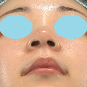 新宿ラクル美容外科クリニック　山本厚志　「小鼻縮小+α法」　手術後６ヶ月目　５月１８日