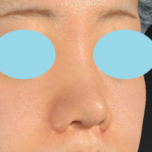 新宿ラクル美容外科クリニック　山本厚志　「貴族手術（鼻翼基部プロテーゼ）＋ 小鼻縮小+α法＋鼻プロテーゼ隆鼻術」　手術前　２月２７日