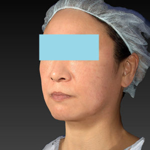 新宿ラクル美容外科クリニック　山本厚志　「アルテミスリフト」　手術前　２月２３日