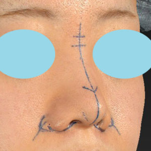 新宿ラクル美容外科クリニック　山本厚志　「貴族手術（鼻翼基部プロテーゼ）＋ 小鼻縮小+α法＋鼻プロテーゼ隆鼻術」　デザイン　２月２７日