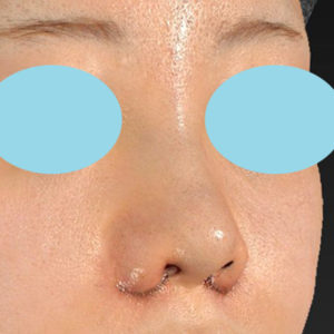 新宿ラクル美容外科クリニック　山本厚志　「貴族手術（鼻翼基部プロテーゼ）＋ 小鼻縮小+α法＋鼻プロテーゼ隆鼻術」　手術直後　２月２７日