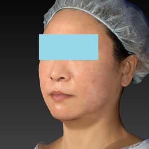 新宿ラクル美容外科クリニック　山本厚志　「アルテミスリフト」　手術直後　２月２３日