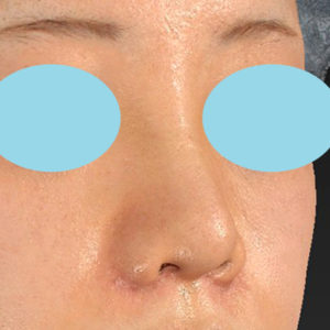 新宿ラクル美容外科クリニック　山本厚志　「貴族手術（鼻翼基部プロテーゼ）＋ 小鼻縮小+α法＋鼻プロテーゼ隆鼻術」　手術後１週間目　２月２７日