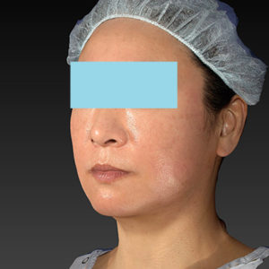 新宿ラクル美容外科クリニック　山本厚志　「アルテミスリフト」　手術後１週間目　２月２３日