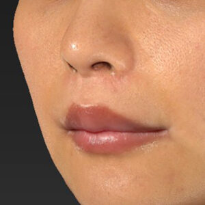 新宿ラクル美容外科クリニック　山本厚志　「人中短縮術（リップリフト）＋口角挙上（スマイルリップ）」　手術後１２ヶ月目　９月４日