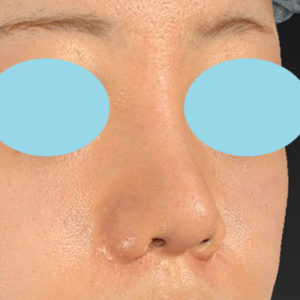 新宿ラクル美容外科クリニック　山本厚志　「貴族手術（鼻翼基部プロテーゼ）＋ 小鼻縮小+α法＋鼻プロテーゼ隆鼻術」　手術後１ヶ月目　２月２７日