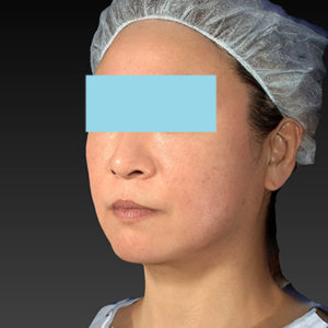 新宿ラクル美容外科クリニック　山本厚志　「アルテミスリフト」　手術後１ヶ月目　２月２３日