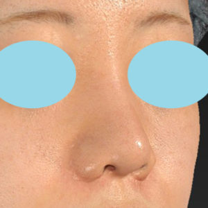 新宿ラクル美容外科クリニック　山本厚志　「貴族手術（鼻翼基部プロテーゼ）＋ 小鼻縮小+α法＋鼻プロテーゼ隆鼻術」　手術後２ヶ月目　３月２２日