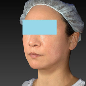 新宿ラクル美容外科クリニック　山本厚志　「アルテミスリフト」　手術後３ヶ月目　3月２３日