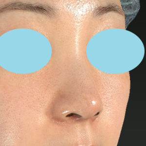 新宿ラクル美容外科クリニック　山本厚志　「小鼻縮小+α法」　手術後６ヶ月目　５月１８日