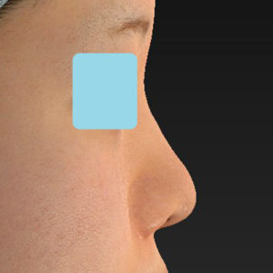 新宿ラクル美容外科クリニック　山本厚志　「貴族手術（鼻翼基部プロテーゼ）＋ 小鼻縮小+α法＋鼻プロテーゼ隆鼻術」　手術前　２月２７日