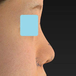 新宿ラクル美容外科クリニック　山本厚志　「貴族手術（鼻翼基部プロテーゼ）＋ 小鼻縮小+α法＋鼻プロテーゼ隆鼻術」　デザイン　２月２７日