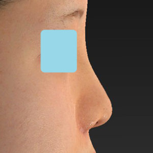 新宿ラクル美容外科クリニック　山本厚志　「貴族手術（鼻翼基部プロテーゼ）＋ 小鼻縮小+α法＋鼻プロテーゼ隆鼻術」　手術後１週間目　２月２７日