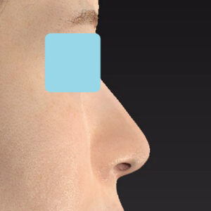 新宿ラクル美容外科クリニック　山本厚志　「小鼻縮小+α法 ＋ 鼻孔縁下降術」　手術後１２ヶ月目　２月２日