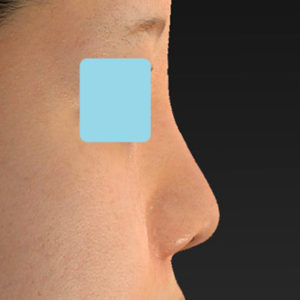 新宿ラクル美容外科クリニック　山本厚志　「貴族手術（鼻翼基部プロテーゼ）＋ 小鼻縮小+α法＋鼻プロテーゼ隆鼻術」　手術後２ヶ月目　３月２２日