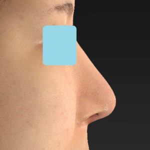 「鼻中隔延長＋耳介軟骨移植＋鼻尖形成＋猫手術＋貴族手術＋鼻骨骨切り幅寄せ」　新宿ラクル美容外科クリニック　２０代女性　手術後３ヶ月目　４月３日