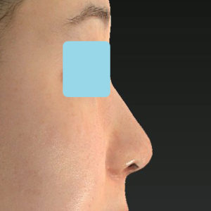 新宿ラクル美容外科クリニック　山本厚志　「小鼻縮小+α法」　手術後６ヶ月目　５月１８日