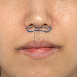 新宿ラクル美容外科クリニック　山本厚志　「人中短縮術（リップリフト）＋口角挙上（スマイルリップ）」　デザイン　３月１７日