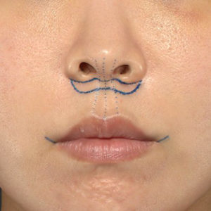 新宿ラクル美容外科クリニック　山本厚志　「人中短縮術（リップリフト）＋口角挙上（スマイルリップ）」　デザイン　４月３日