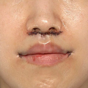 新宿ラクル美容外科クリニック　山本厚志　「人中短縮術（リップリフト）＋口角挙上（スマイルリップ）」　手術直後　３月１７日
