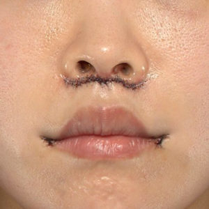 新宿ラクル美容外科クリニック　山本厚志　「人中短縮術（リップリフト）＋口角挙上（スマイルリップ）」　手術直後　４月３日