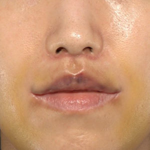 新宿ラクル美容外科クリニック　山本厚志　「人中短縮術（リップリフト）＋口角挙上（スマイルリップ）」　手術後１週間目　３月１７日
