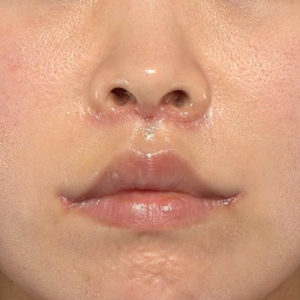 新宿ラクル美容外科クリニック　山本厚志　「人中短縮術（リップリフト）＋口角挙上（スマイルリップ）」　手術後１週間目　４月３日