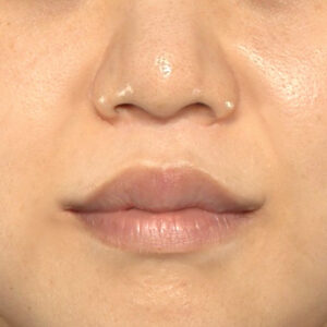 新宿ラクル美容外科クリニック　山本厚志　「人中短縮術（リップリフト）＋口角挙上（スマイルリップ）」　手術後１２ヶ月目　９月２７日