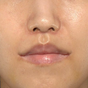 新宿ラクル美容外科クリニック　山本厚志　「人中短縮術（リップリフト）＋口角挙上（スマイルリップ）」　手術後１ヶ月目　３月１７日