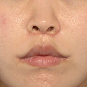 新宿ラクル美容外科クリニック　山本厚志　「人中短縮術（リップリフト）＋口角挙上（スマイルリップ）」　手術後１ヶ月目　４月３日