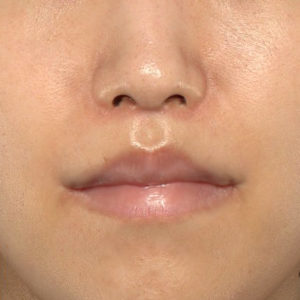 新宿ラクル美容外科クリニック　山本厚志　「人中短縮術（リップリフト）＋口角挙上（スマイルリップ）」　手術後２ヶ月目　３月１７日