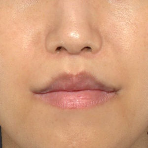 新宿ラクル美容外科クリニック　山本厚志　「人中短縮術（リップリフト）＋口角挙上（スマイルリップ）」　手術後３ヶ月目　４月２１日