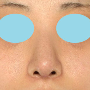 「鼻中隔延長＋耳介軟骨移植＋鼻尖形成＋ワシ鼻修正（ハンプ切除）」　新宿ラクル美容外科クリニック　２０代女性　手術後６ヶ月目　５月１９日