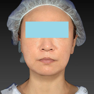 新宿ラクル美容外科クリニック　山本厚志　「アルテミスリフト」　手術後６ヶ月目　５月３１日