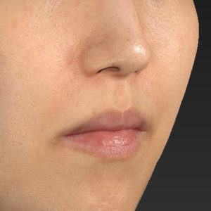 新宿ラクル美容外科クリニック　山本厚志　「人中短縮術（リップリフト）＋口角挙上（スマイルリップ）」　手術前　３月１７日