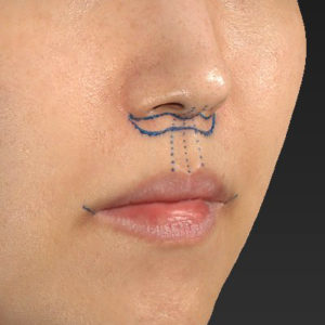 新宿ラクル美容外科クリニック　山本厚志　「人中短縮術（リップリフト）＋口角挙上（スマイルリップ）」　デザイン　３月１７日