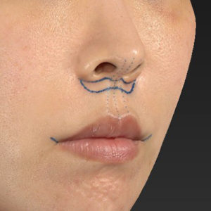 新宿ラクル美容外科クリニック　山本厚志　「人中短縮術（リップリフト）＋口角挙上（スマイルリップ）」　デザイン　４月３日