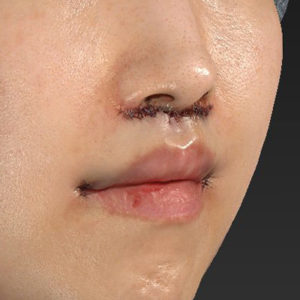 新宿ラクル美容外科クリニック　山本厚志　「人中短縮術（リップリフト）＋口角挙上（スマイルリップ）」　手術直後　３月１７日