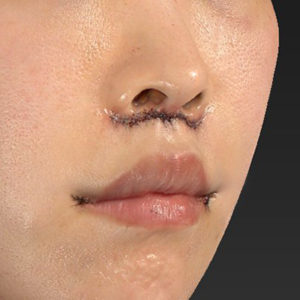 新宿ラクル美容外科クリニック　山本厚志　「人中短縮術（リップリフト）＋口角挙上（スマイルリップ）」　手術直後　４月３日