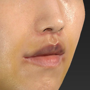 新宿ラクル美容外科クリニック　山本厚志　「人中短縮術（リップリフト）＋口角挙上（スマイルリップ）」　手術後１週間目　３月１７日